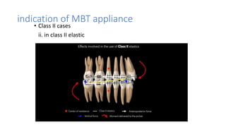 Mbt Class Brackets _versatility _ final (new).pptx