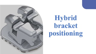 Brackets _versatility _ final (new).pptx
