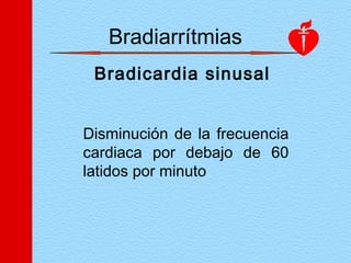 Bradiarrítmias
Bradicardia sinusal
Disminución de la frecuencia
cardiaca por debajo de 60
latidos por minuto
 