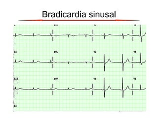 Bradicardia sinusal
 