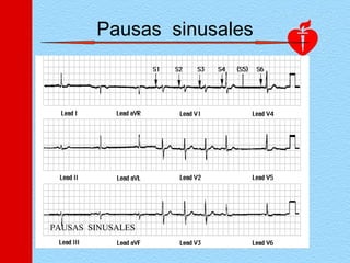 PAUSAS SINUSALES
Pausas sinusales
 