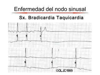 Enfermedad del nodo sinusal
Sx. Bradicardia Taquicardia
 