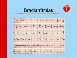 Bradiarrítmias
 
