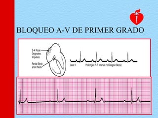 BLOQUEO A-V DE PRIMER GRADO
 