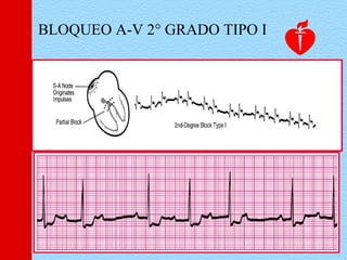 BLOQUEO A-V 2° GRADO TIPO I
 