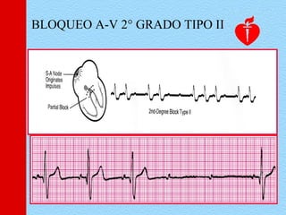 BLOQUEO A-V 2° GRADO TIPO II
 
