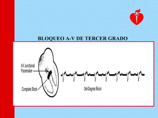 BLOQUEO A-V DE TERCER GRADO
 