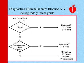 Mas P’s que QRS
PR fijo?
No
Intervalo R-R
Se ve
regular?
No
Si
Si
Si
BloqueoAV
2° Grado
Mobitz II
BloqueoAV
3° Grado
BloqueoAV
2° Grado
Mobitz I
(Wenckebach)
Diagnóstico diferencial entre Bloqueo A-V
de segundo y tercer grado
 