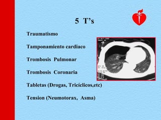 Traumatismo
Tamponamiento cardiaco
Trombosis Pulmonar
Trombosis Coronaria
Tabletas (Drogas, Tricíclicos,etc)
Tension (Neumotorax, Asma)
5 T’s
 