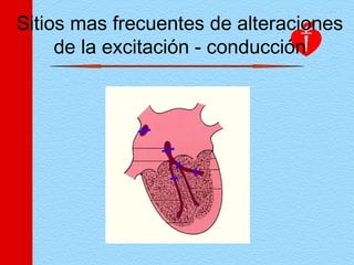 Sitios mas frecuentes de alteraciones
de la excitación - conducción
 