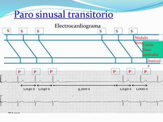 S
S
S S S S
Nódulo
Sinusal
Unión
Sino-
auricular
Aurícul
a
P P P P P P
1,040 s 1,040 s 4,200 s 1,040 s 1,000 s
Paro sinusal transitorio
Electrocardiograma
 