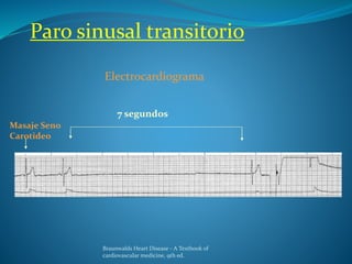 Paro sinusal transitorio
Masaje Seno
Carotideo
7 segundos
Electrocardiograma
Braunwalds Heart Disease - A Textbook of
cardiovascular medicine, 9th ed.
 