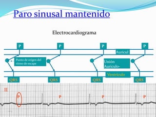 P
Paro sinusal mantenido
Electrocardiograma
P P P
Unión
Auriculo-
Ventricular
Aurícul
a
Ventrículo
QRS QRS QRS QRS
P
Punto de origen del
ritmo de escape
P P P
II
 