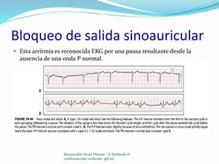 Bloqueo de salida sinoauricular
 Esta arritmia es reconocida EKG por una pausa resultante desde la
ausencia de una onda P normal.
Braunwalds Heart Disease - A Textbook of
cardiovascular medicine, 9th ed.
 