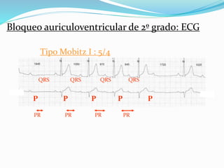 Tipo Mobitz I : 5/4
Bloqueo auriculoventricular de 2º grado: ECG
P P P P P
PR PR PR PR
QRS QRS QRS QRS
 