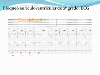Bloqueo auriculoventricular de 2º grado: ECG
Tipo Mobitz II
P P P P
 