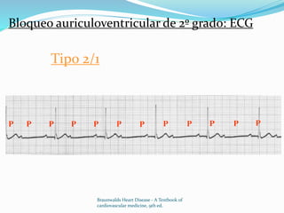 Bloqueo auriculoventricular de 2º grado: ECG
Tipo 2/1
P P P P P P P P P P PP
Braunwalds Heart Disease - A Textbook of
cardiovascular medicine, 9th ed.
 
