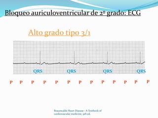 Braunwalds Heart Disease - A Textbook of
cardiovascular medicine, 9th ed.
Bloqueo auriculoventricular de 2º grado: ECG
Alto grado tipo 3/1
P P P P P P P P P P PP P
QRS QRS QRS QRS
 
