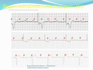 Bloqueo auriculoventricular de 3er grado: ECG
PP P P PP P P P P P
P P P P PP PP P
P P PP PP PP P
A
B
C
Braunwalds Heart Disease - A Textbook of
cardiovascular medicine, 9th ed.
 