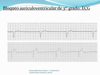 Bloqueo auriculoventricular de 3er grado: ECG
A
B
Braunwalds Heart Disease - A Textbook of
cardiovascular medicine, 9th ed.
 