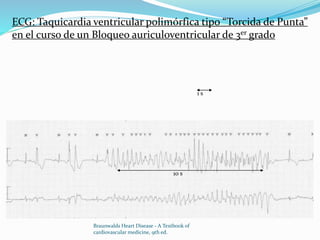 ECG: Taquicardia ventricular polimórfica tipo “Torcida de Punta”
en el curso de un Bloqueo auriculoventricular de 3er grado
1 s
10 s
Braunwalds Heart Disease - A Textbook of
cardiovascular medicine, 9th ed.
 