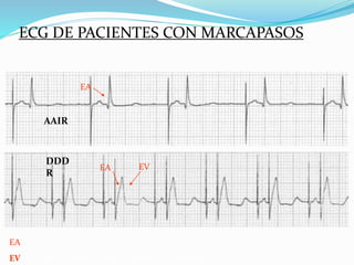 DDD
R
ECG DE PACIENTES CON MARCAPASOS
EA EV
EA: Espícula de marcapasos que estimula en aurícula
EV: Espícula de marcapasos que estimula en ventrículo
EA
AAIR
 