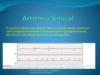 Es caracterizada por una variación fásica en el ciclo sinusal, durante el
cual la longitud máxima del ciclo sinusal menos la longitud mínima
del ciclo del ciclo sinusal supera los 120 milisegundos.
Braunwalds Heart Disease - A Textbook of
cardiovascular medicine, 9th ed.
 