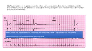 61 años, sin factores de riesgo cardiovascular ni ttos. Mareos ocasionales. Expl. Normal. ECG de reposo sólo
bradicardia sinusal a 55 lpm. En cardio se le realizó un Holter y se registran periodos repetidos de “bradicardia”
que coincidían con mareos.
ritmo sinusal con periodos de BAV paroxístico con intervalo R-R de 4,2 seg sintomáticos por mareos.
Se colocó marcapasos bicameral con buena respuesta.
 