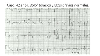 Caso: 42 años. Dolor torácico y EKGs previos normales.
 