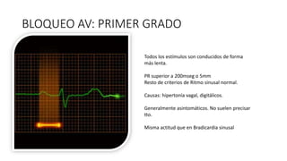 BLOQUEO AV: PRIMER GRADO
Todos los estímulos son conducidos de forma
más lenta.
PR superior a 200mseg o 5mm
Resto de criterios de Ritmo sinusal normal.
Causas: hipertonía vagal, digitálicos.
Generalmente asintomáticos. No suelen precisar
tto.
Misma actitud que en Bradicardia sinusal
 