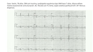 Caso: Varón, 78 años. DM con insulina, cardiopatía isquémica tipo IAM hace 7 años. Ahora refiere
mareo ocasional de corta duración. AC: RsCsAs con FC lenta, soplo sistólico panfocal II/VI. AP: Roncus
dispersos.
 