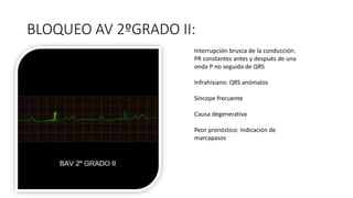 BLOQUEO AV 2ºGRADO II:
Interrupción brusca de la conducción:
PR constantes antes y después de una
onda P no seguida de QRS
Infrahisiano: QRS anómalos
Síncope frecuente
Causa degenerativa
Peor pronóstico: Indicación de
marcapasos
 
