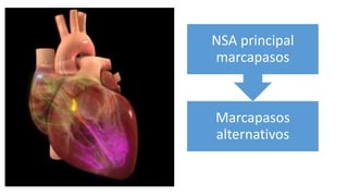 Marcapasos
alternativos
NSA principal
marcapasos
 