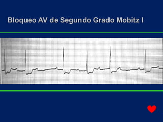 Bloqueo AV de Segundo Grado Mobitz I
 