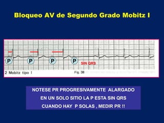 P P P P SIN QRS
NOTESE PR PROGRESIVAMENTE ALARGADO
EN UN SOLO SITIO LA P ESTA SIN QRS
CUANDO HAY P SOLAS , MEDIR PR !!
Bloqueo AV de Segundo Grado Mobitz I
 