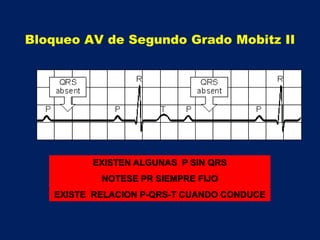 EXISTEN ALGUNAS P SIN QRS
NOTESE PR SIEMPRE FIJO
EXISTE RELACION P-QRS-T CUANDO CONDUCE
Bloqueo AV de Segundo Grado Mobitz II
 