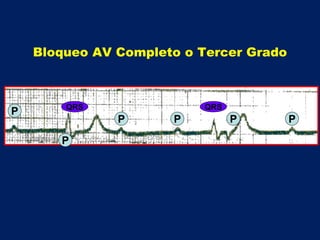 P
P
P P P P
QRS QRS
Bloqueo AV Completo o Tercer Grado
 