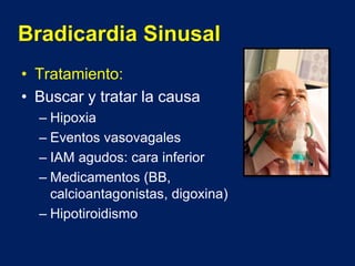 Bradicardia Sinusal
• Tratamiento:
• Buscar y tratar la causa
– Hipoxia
– Eventos vasovagales
– IAM agudos: cara inferior
– Medicamentos (BB,
calcioantagonistas, digoxina)
– Hipotiroidismo
 