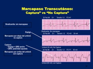 27
Marcapaso Transcutáneo:
Captura” vs “No Captura”
Marcapaso por abajo del umbral:
no captura
Marcapaso por arriba del umbral:
con captura
Espiga
Captura:
• Espiga + QRS ancho
• QRS: polaridad opuesta
25 Feb 88 D I Tamaño 1.0 FC=41
25 Feb 88 D I Tamaño 1.0 FC=43 35 mA
25 Feb 88 D I Tamaño 1.0 FC=71 60 mA
Bradicardia: Sin marcapaso
Umbral (35 mA): No Captura
Umbral (60 mA): con Captura
Bradicardia: sin marcapaso
 