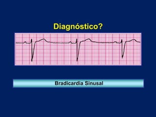Diagnóstico?
Bradicardia Sinusal
 