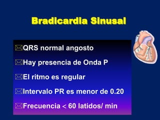 Bradicardia Sinusal
QRS normal angosto
Hay presencia de Onda P
El ritmo es regular
Intervalo PR es menor de 0.20
Frecuencia  60 latidos/ min
 