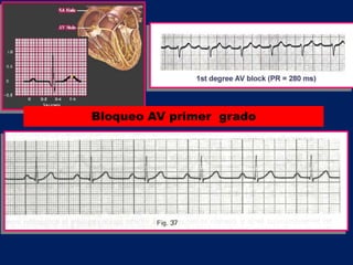 Bloqueo AV primer grado
 
