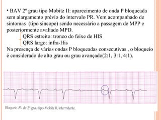 BAV 2º grau tipo Mobitz II: aparecimento de onda P bloqueada sem alargamento prévio do intervalo PR. Vem acompanhado de sintomas  (tipo sincope) sendo necessário a passagem de MPP e posteriormente avaliado MPD. QRS estreito: tronco do feixe de HIS  QRS largo: infra-His Na presença de várias ondas P bloqueadas consecutivas , o bloqueio é considerado de alto grau ou grau avançado(2:1, 3:1, 4:1). 