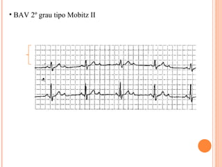 BAV 2º grau tipo Mobitz II 