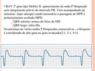 BAV 2º grau tipo Mobitz II: aparecimento de onda P bloqueada sem alargamento prévio do intervalo PR. Vem acompanhado de sintomas  (tipo sincope) sendo necessário a passagem de MPP e posteriormente avaliado MPD. QRS estreito: tronco do feixe de HIS  QRS largo: infra-His Na presença de várias ondas P bloqueadas consecutivas , o bloqueio é considerado de alto grau ou grau avançado(2:1, 3:1, 4:1). 