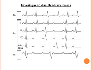 Investigação das Bradiarritmias 