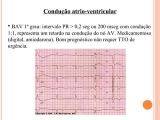 Condução atrio-ventricular BAV 1º grau: intervalo PR > 0,2 seg ou 200 mseg com condução 1:1, representa um retardo na condução do nó AV. Medicamentoso (digital, amiodarona). Bom prognóstico não requer TTO de urgência.  