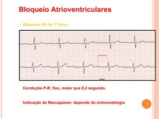 Condução P-R, fixa, maior que 0,2 segundo. Indicação de Marcapasso: depende da sintomatologia Bloqueio Atrioventriculares Bloqueio AV de 1º Grau 