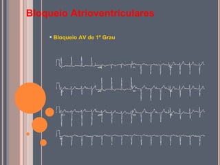 Bloqueio Atrioventriculares Bloqueio AV de 1º Grau 