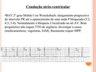 Condução atrio-ventricular BAV 2º grau Mobitz I ou Wenckebach: alargamento progressivo do intervalo PR até o aparecimento de uma onda P bloqueada (3:2, 4:3, 5:4). Normalmente o bloqueio é localizado no nó AV. Bom prognóstico não requer TTO de urgência. Investigar a causa (medicamentoso, vagotonia, IAM). Raramente requer MPP. 